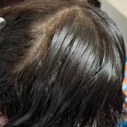 Tips for Choosing a Professional Lice Treatment Service