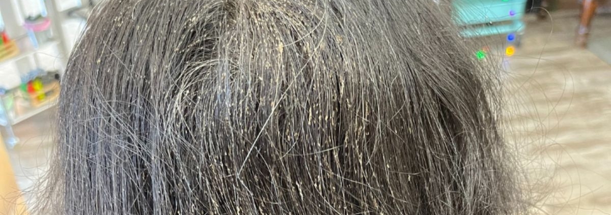 What Happens if Head Lice Goes Untreated?