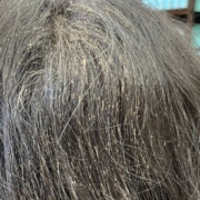 What Happens if Head Lice Goes Untreated?