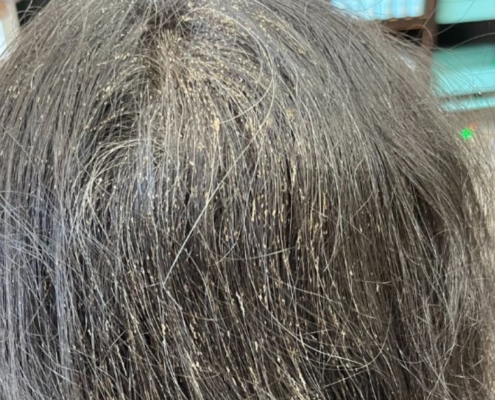 What Happens if Head Lice Goes Untreated?