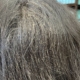 What Happens if Head Lice Goes Untreated?