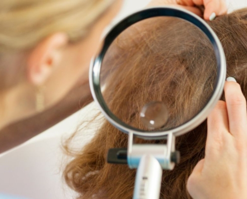 The Benefits of Professional Head Lice Removal Services