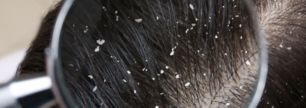 How To Tell the Difference Between Lice and Dandruff