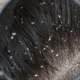 How To Tell the Difference Between Lice and Dandruff