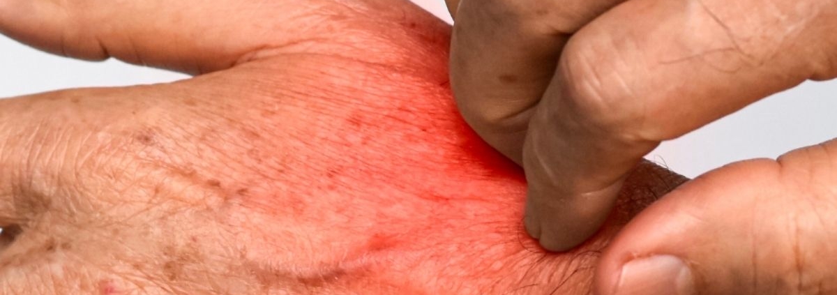 What’s the Difference Between Lice and Scabies?