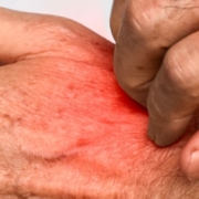 What’s the Difference Between Lice and Scabies?