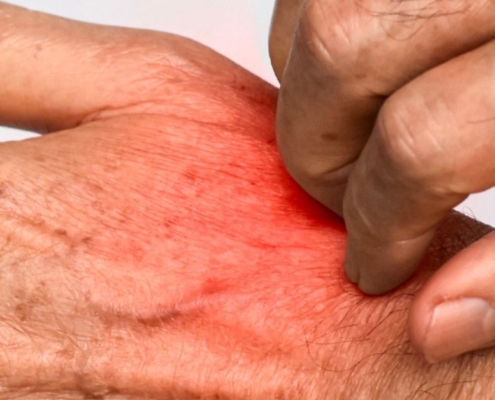 What’s the Difference Between Lice and Scabies?