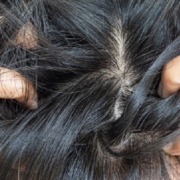 Reasons Your Head Still Itches After Lice Treatment