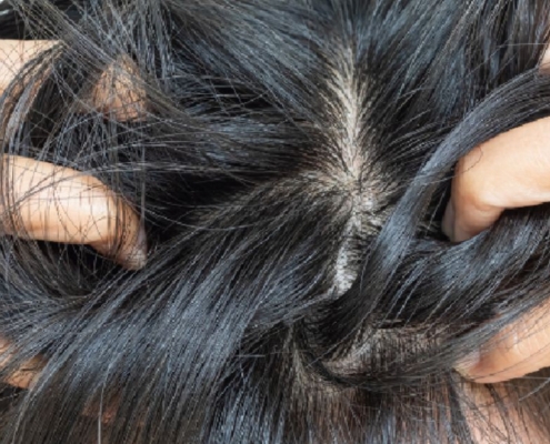 Reasons Your Head Still Itches After Lice Treatment